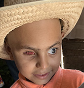 ALexis, blind child after remaining eye had been removed.